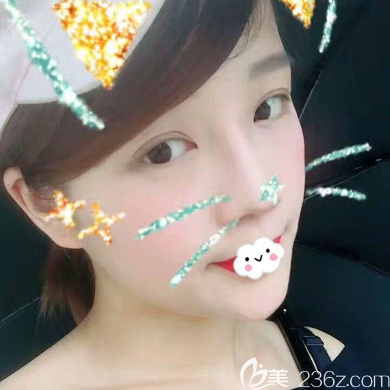 黄石中爱万文勇隆鼻好吗?自体软骨隆鼻案例见分晓 黄石中爱万文勇隆鼻好吗?自体软骨隆鼻案例见分晓