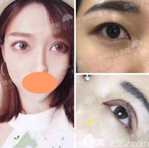 乐金堂眼综合整形案例术后一个月效果图