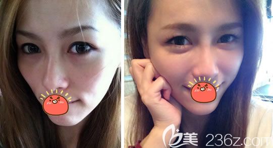 东阳丽莱庄军达自体脂肪填充案例