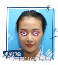 在北京碧莲盛做下调发际线+额角种植加密前样子 在北京碧莲盛做下调发际线+额角种植加密前样子