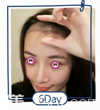 杨志详医生给我做下调发际线+额角种植加密第六天样子 杨志详医生给我做下调发际线+额角种植加密第六天样子