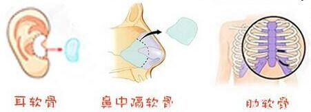自体软骨隆鼻 自体软骨隆鼻
