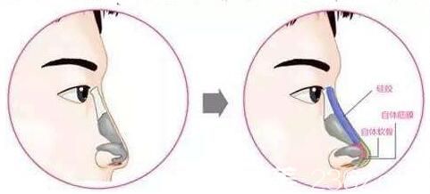 自体软骨隆鼻和硅胶隆鼻那个更好? 自体软骨隆鼻和硅胶隆鼻那个更好?