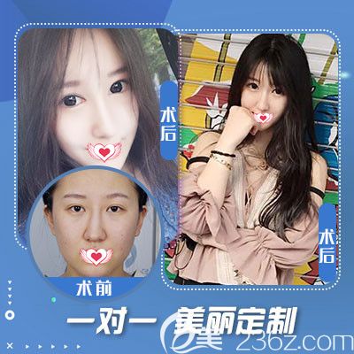 石家庄蓝山整形医院鼻综合案例 石家庄蓝山整形医院鼻综合案例