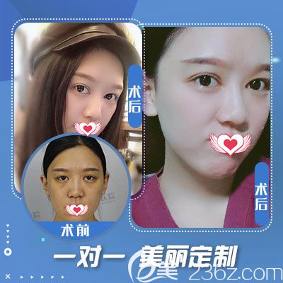 蓝山整形医院双眼皮案例 蓝山整形医院双眼皮案例
