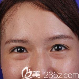 内切去眼袋术前照片 内切去眼袋术前照片
