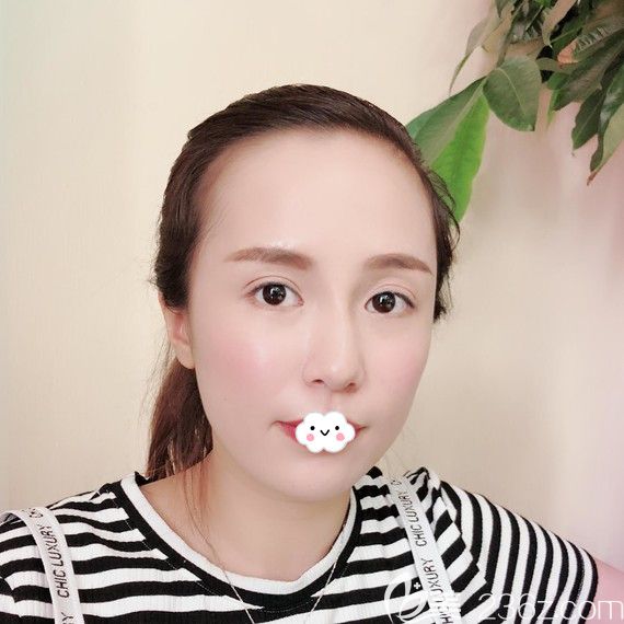 武汉莱美整形美容医院祛眼袋术后恢复照片 武汉莱美整形美容医院祛眼袋术后恢复照片