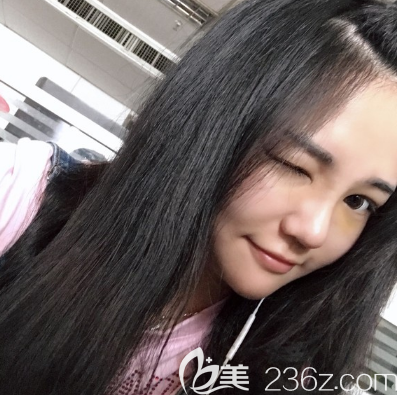 在广州美恩做完隆鼻隆下巴10天效果图 在广州美恩做完隆鼻隆下巴10天效果图