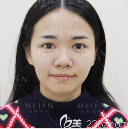去广州美恩隆鼻术前照片 去广州美恩隆鼻术前照片