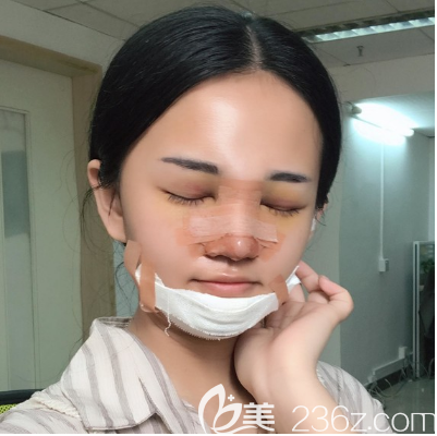 广州美恩隆鼻+丰下巴术后三天 广州美恩隆鼻+丰下巴术后三天