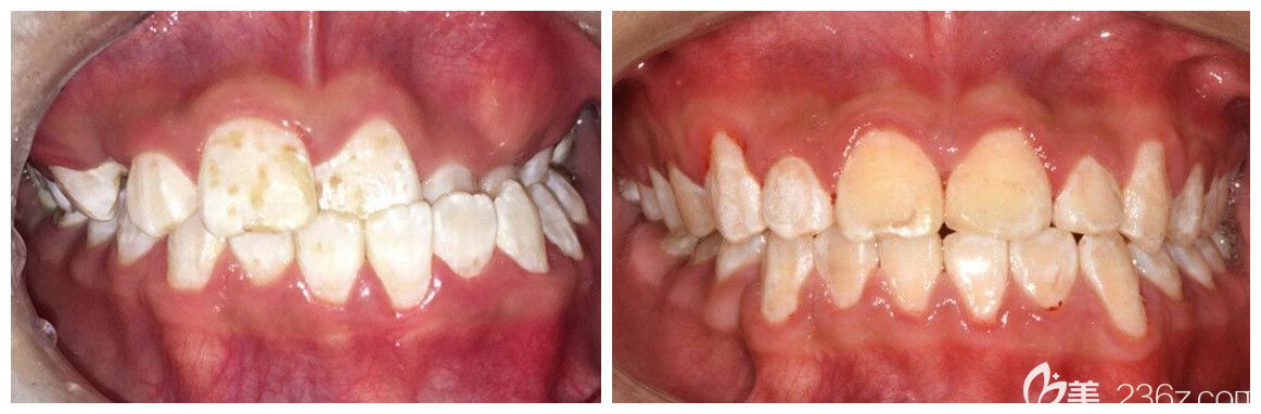 北京中诺口腔柯松林正畸案例 北京中诺口腔柯松林正畸案例