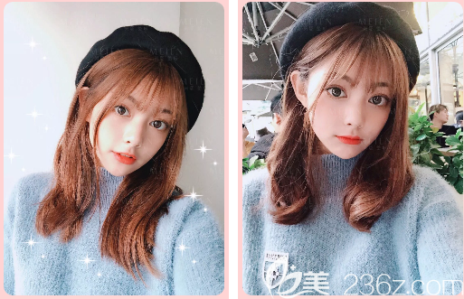 广州美恩陈宏彬全脸脂肪填充3天照片 广州美恩陈宏彬全脸脂肪填充3天照片