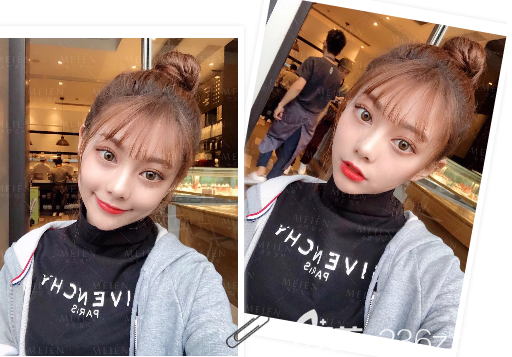 广州美恩陈宏彬脂肪填充案例图片 广州美恩陈宏彬脂肪填充案例图片