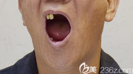 詹大爷去北京中诺口腔做种牙前的牙齿状况 詹大爷去北京中诺口腔做种牙前的牙齿状况