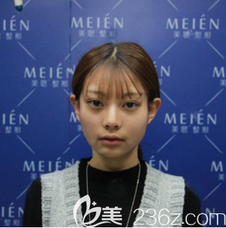 在广州美恩做脂肪填充术前照片 在广州美恩做脂肪填充术前照片
