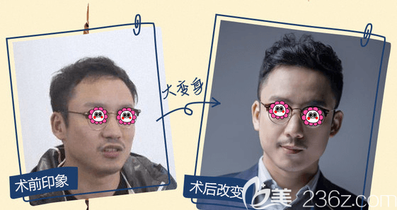 北京碧莲盛发际线种植案例