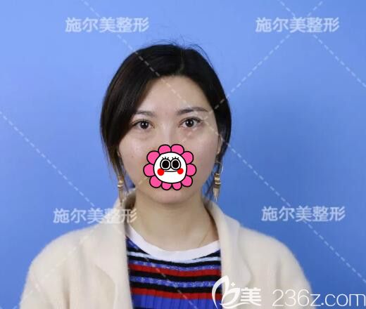 面诊江苏施尔美术前眼袋明显 面诊江苏施尔美术前眼袋明显