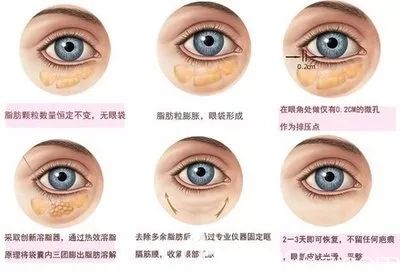 医美整形去眼袋手术方法原理 医美整形去眼袋手术方法原理