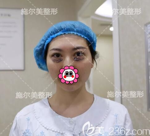 孙欣主任术前划线设计去眼袋 孙欣主任术前划线设计去眼袋