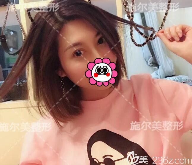 找孙欣主任做去眼袋术后半年恢复效果 找孙欣主任做去眼袋术后半年恢复效果