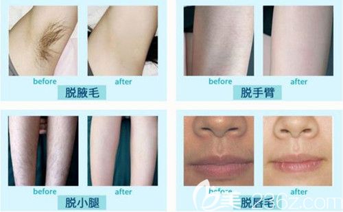 沈阳百嘉丽整形脱毛真人前后效果对比 沈阳百嘉丽整形脱毛真人前后效果对比