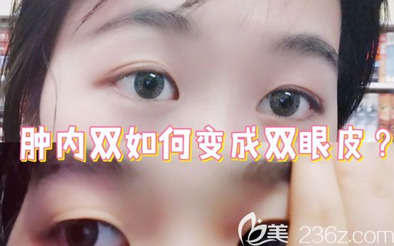 东阳横店丽莱整形割双眼皮怎么样?整理一份丽莱双眼皮隆鼻价格及案例效果图