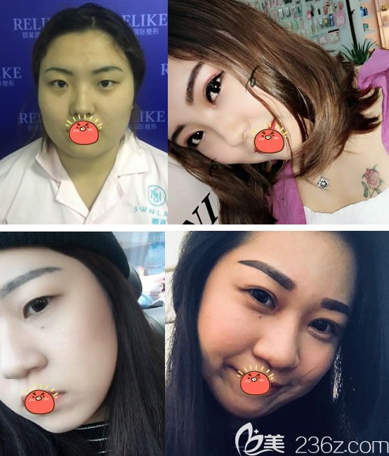 东阳横店丽莱割双眼皮案例