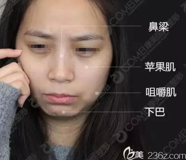 南京康美医生面诊设计玻尿酸+瘦脸方案