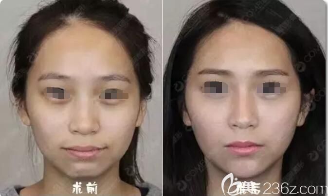 到<!--<i data=20240703-sp></i>-->注射玻尿酸瘦脸术后即刻对比