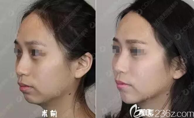 注射玻尿酸填充+瘦脸除皱瘦脸术后侧面对比照
