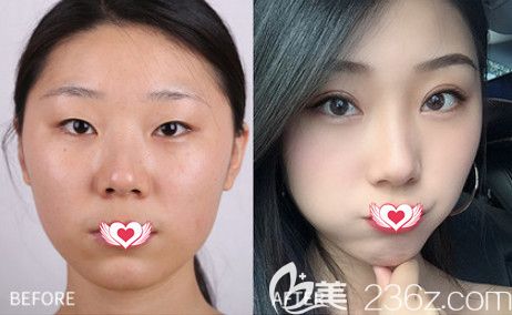 来看邯郸维多利亚整形3月8日女神节超值优惠美丽攻略 1680元就能get自然款双眼皮