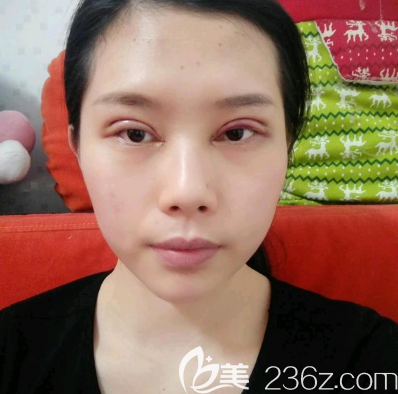 广州韩妃双眼皮术后两天效果 广州韩妃双眼皮术后两天效果