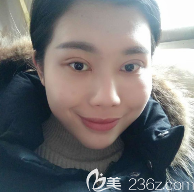 广州韩妃于洪瑞双眼皮术后15天自拍