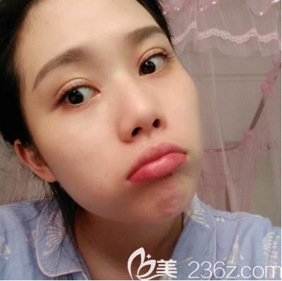 广州韩妃于洪瑞医生做双眼皮怎么样 广州韩妃于洪瑞医生做双眼皮怎么样