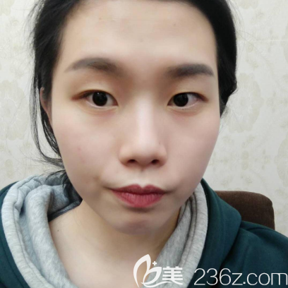 在广州韩妃做双眼皮的术前照片 在广州韩妃做双眼皮的术前照片