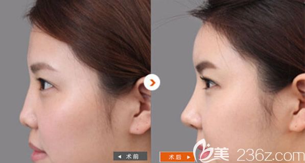 包头华美整形李成飞医生自体软骨综合隆鼻案例 包头华美整形李成飞医生自体软骨综合隆鼻案例