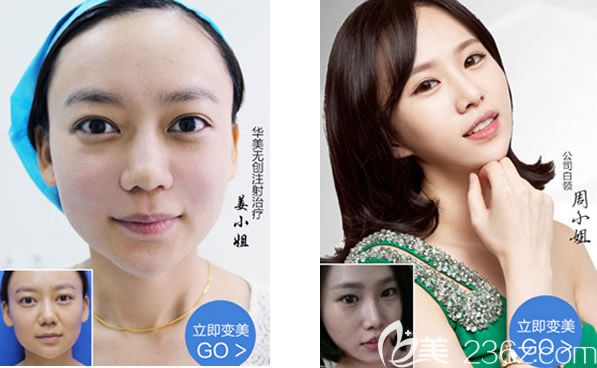 包头华美医疗美容医院注射玻尿酸和瘦脸除皱除皱案例 包头华美医疗美容医院注射玻尿酸和瘦脸除皱除皱案例