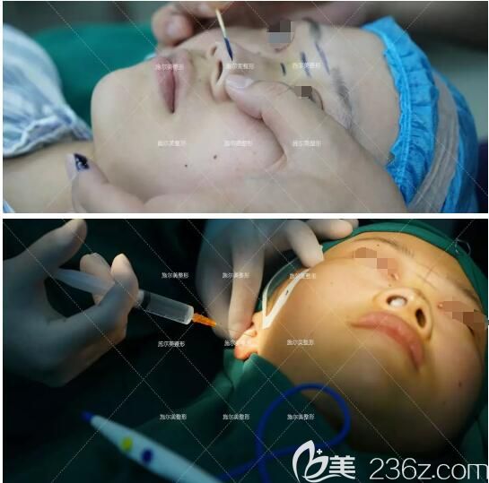 南京施尔美医生做耳软骨综合隆鼻手术中