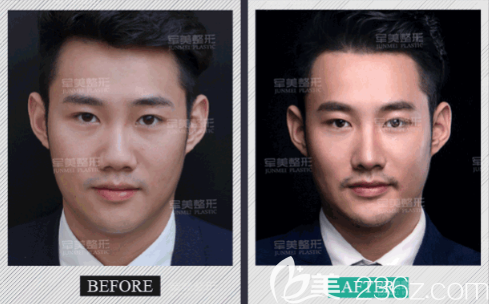 重庆军美假体隆鼻案例 重庆军美假体隆鼻案例