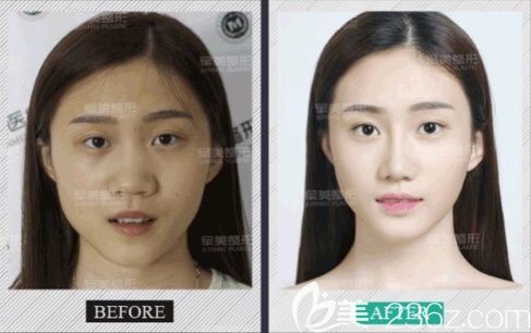 重庆军美哪个医生隆鼻好 重庆军美哪个医生隆鼻好