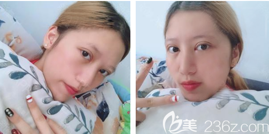 广州韩妃王媛医生双眼皮案例9天图片 广州韩妃王媛医生双眼皮案例9天图片
