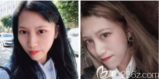 广州韩妃王媛医生双眼皮术后两个月图片 广州韩妃王媛医生双眼皮术后两个月图片