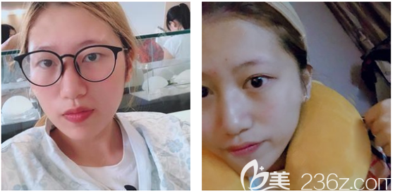 广州韩妃双眼皮术前照片 广州韩妃双眼皮术前照片