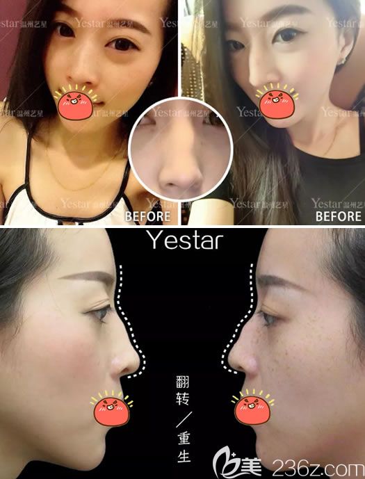 温州艺星做驼峰鼻矫正术前 温州艺星做驼峰鼻矫正术前