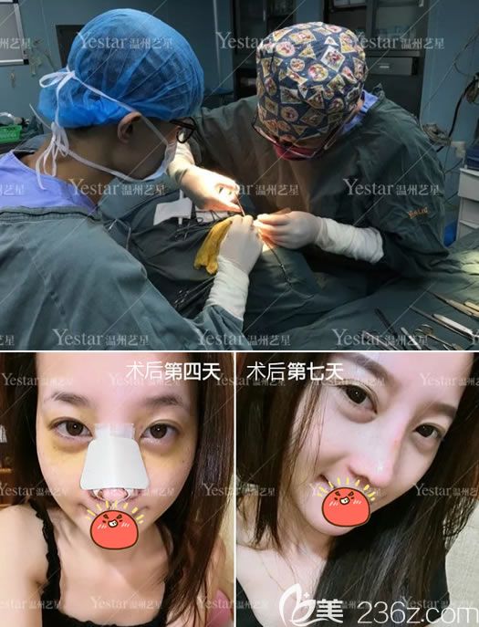 温州艺星整形驼峰鼻矫正手术过程