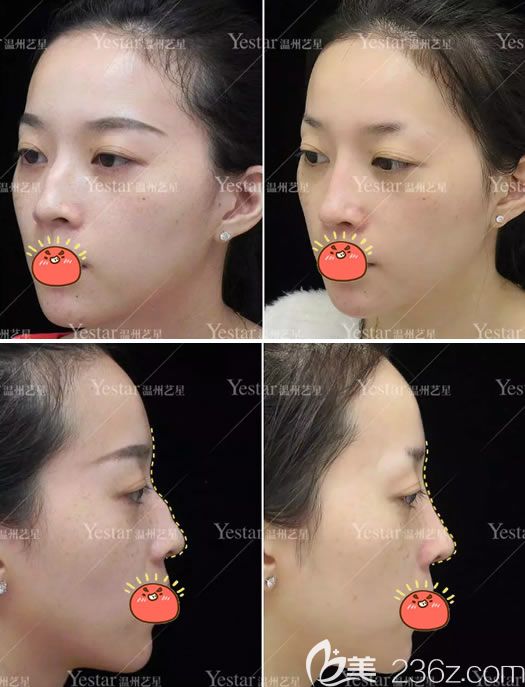 温州艺星驼峰鼻矫正<span style= 温州艺星驼峰鼻矫正<span style=