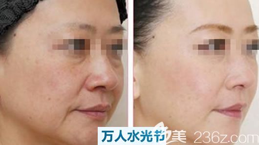 嘉兴禾美无水水光美肤案例