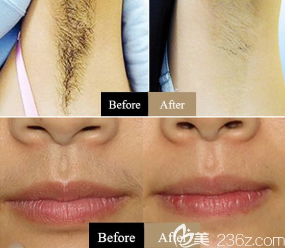 嘉兴禾美整形激光脱毛案例