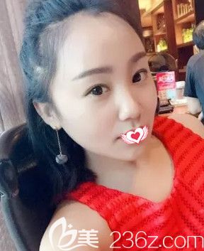 在石家庄蓝山做眼综合术前双眼皮较窄 在石家庄蓝山做眼综合术前双眼皮较窄