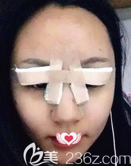 王兴奎院长为我刚做完眼综合术后眼睛肿胀 王兴奎院长为我刚做完眼综合术后眼睛肿胀